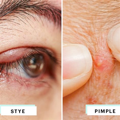 The swelling and pimple that you are describing may be related to the tear duct, which is in that area. . Pimple under eye bag meaning